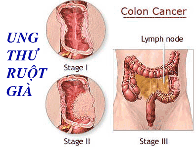 Ảnh 1 của Colon cancer